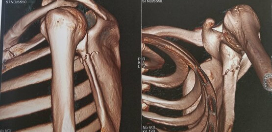 scapula fracture